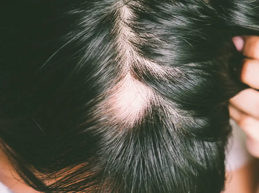 androgenetiki-alopekia-mydermaclinic.gr